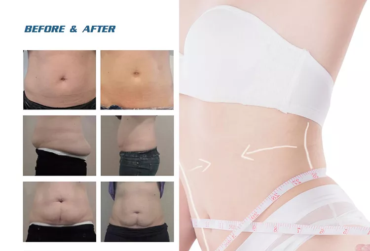 2022 Factory Sale 360 Cryolipolysis Slimming Machine / Fat Freezing Machine Cool Tech Cellulite Reduction