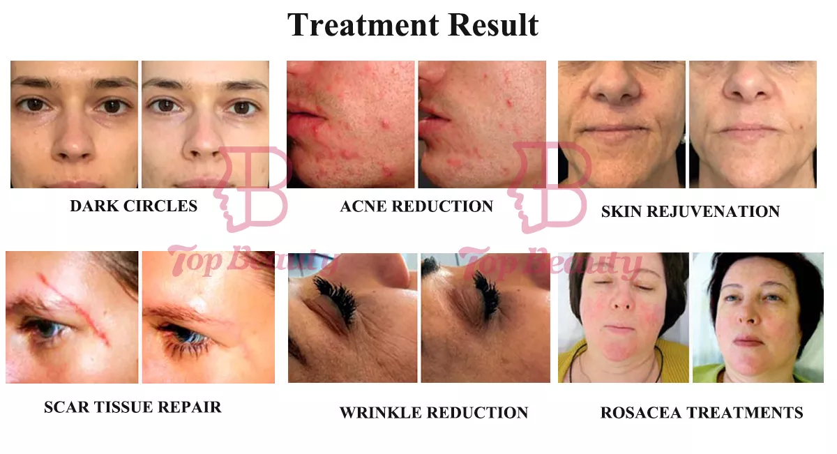 6 In 1 Portable PDT Photon Light Facial Therapy 6 Colors LED Face PDT Light RF skin tighten Hydro Facial Machine
