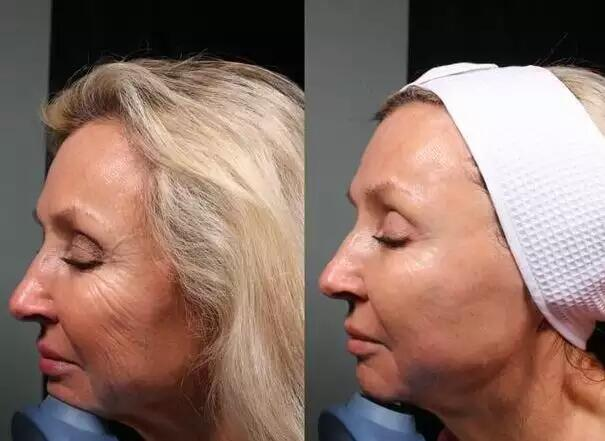 8D HIFU Vmax Hifu Face Lift Beauty Face Wrinkle Remover Body Slimming High Intensity Focused Ultrasound Beauty Machine