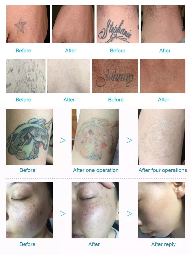 Q Switch Nd Yag Laser Pico Laser Pigment Tattoo Removal Machine
