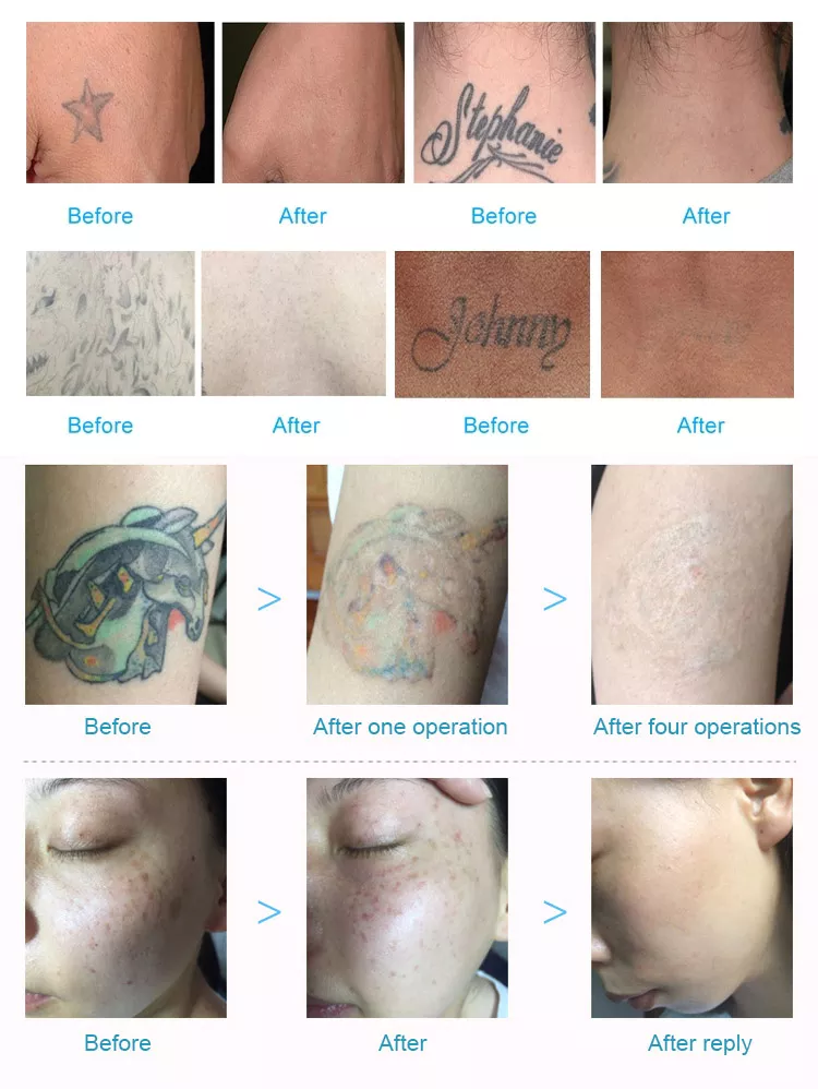 Q Switch Nd Yag Laser Pico Laser Pigment Tattoo Removal Machine