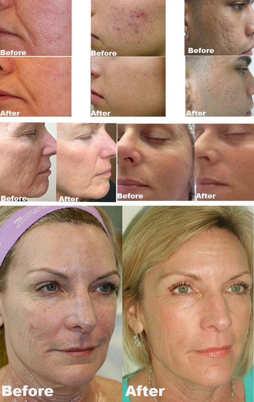 Professional 40.68 MHz RF skin tightening machine