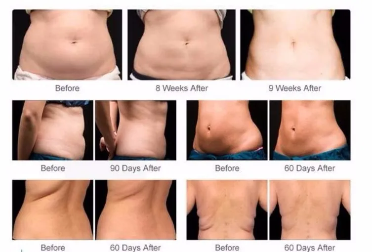 Best price cryolipolysis slimming machine cryotherapy weight lose fat freezing