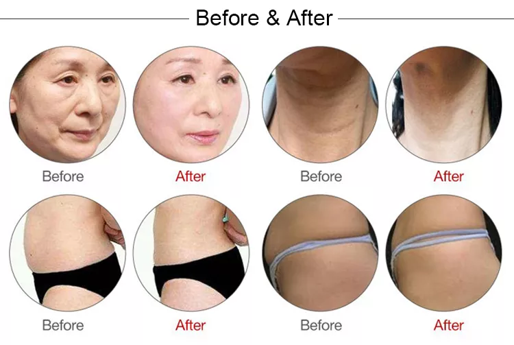360 ° rotate display ultrasound skin rejuvenation Wrinkle Removal vertical 4D MMFU Machine