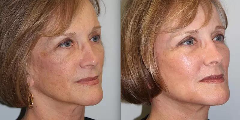 Radio Frequency Machine Mmfu Cyclone Rf Painless Face Lift Rf Machine For Skin Tightening Wrinkle Remover