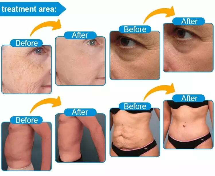 8D HIFU Vmax Hifu Face Lift Beauty Face Wrinkle Remover Body Slimming High Intensity Focused Ultrasound Beauty Machine