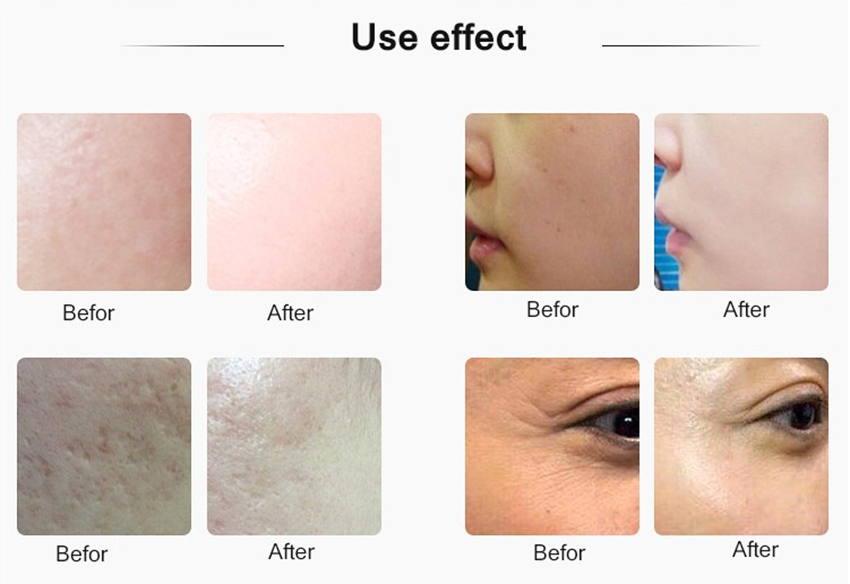 Ultrasound Microneedle Rf Mesotherapy Injection Gun Skin Care device