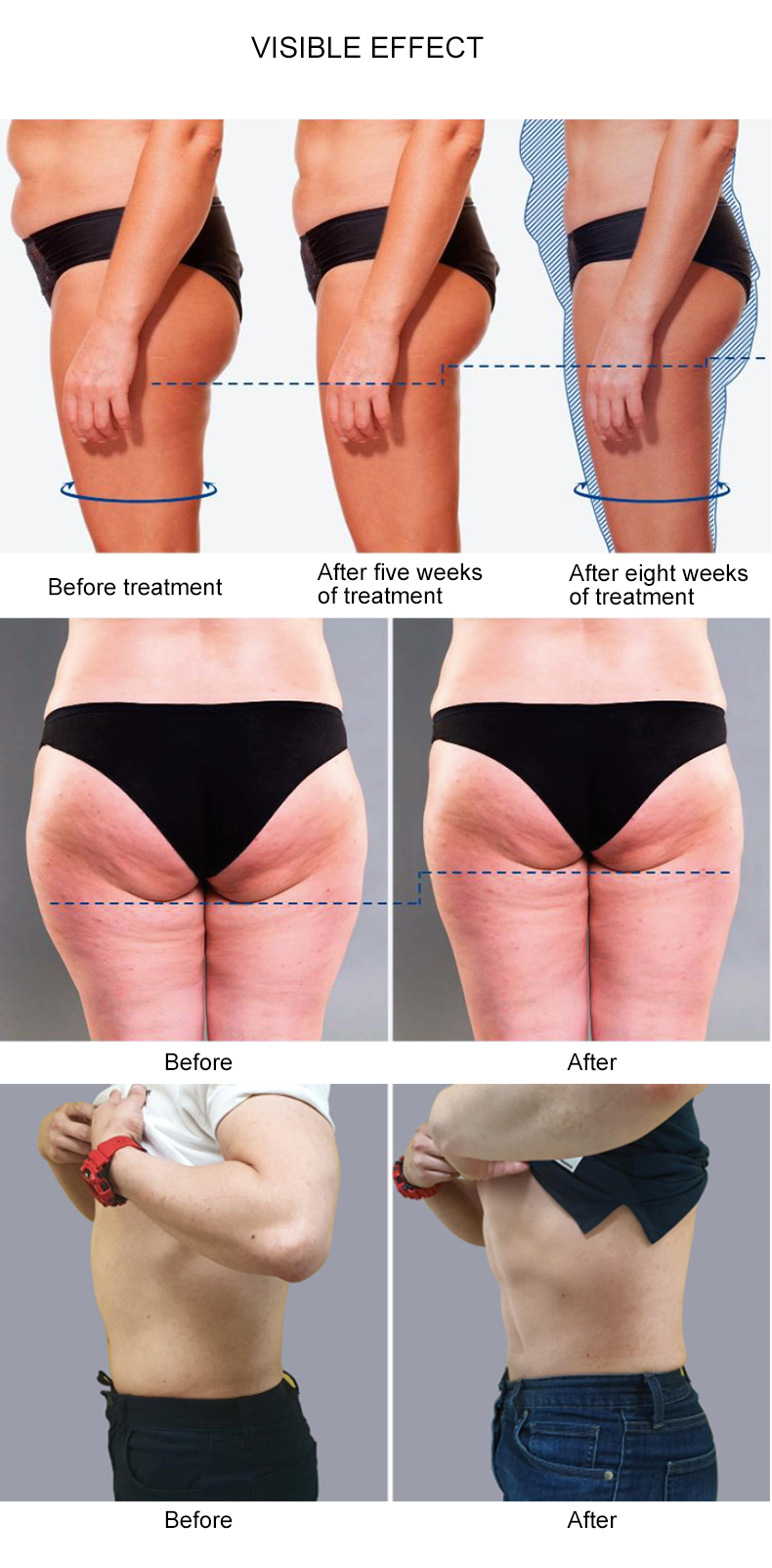 2 in 1 smas RF shockwave therapy machine for cellulite