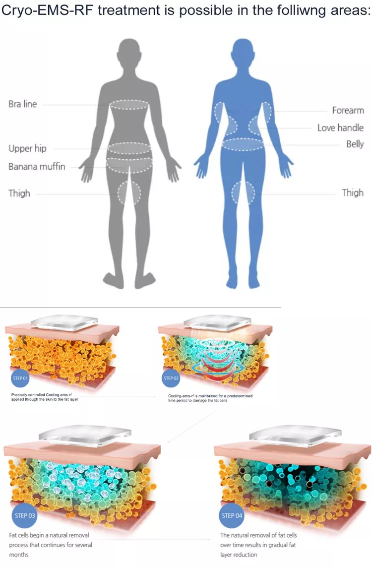2023 New Fat Loss Cryo Pads Slimming Machine Cryolipolysis Machine Coldtec Fat Freeze Cryolipolysis Device