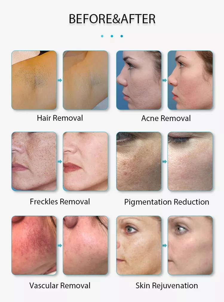 New type intense pulsed light therapy IPL hair removal machine
