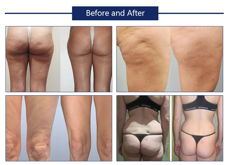 Best price cryolipolysis slimming machine cryotherapy weight lose fat freezing