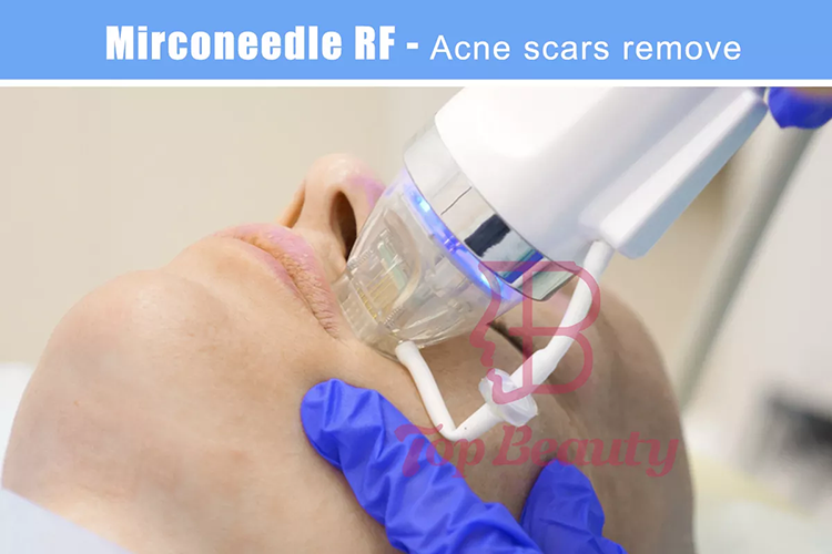 microneedling fractional rf microneedle machine