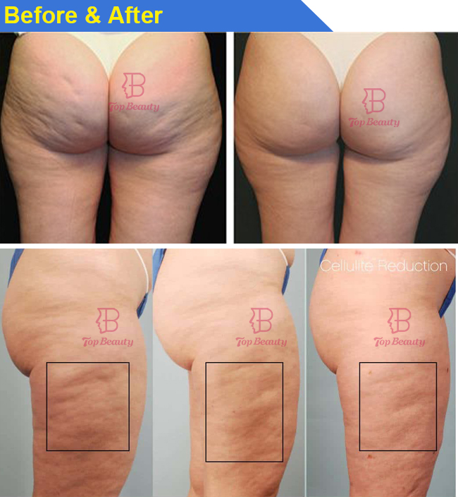 Endospheres roller massage cellulite machine