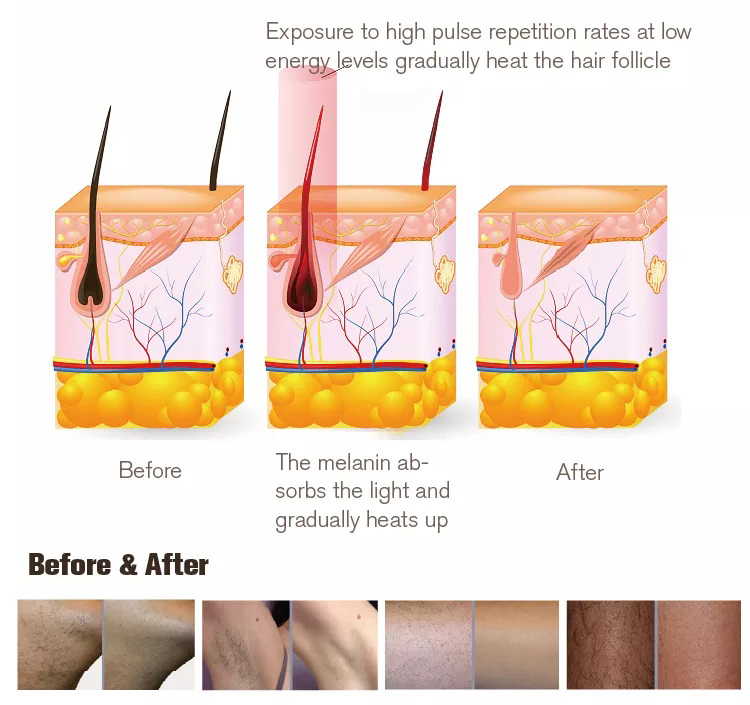 New type intense pulsed light therapy IPL hair removal machine