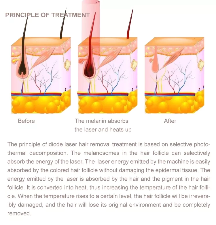 Dual Handles 3 Wavelength Laser Diode 808Nm Hair Removal Treatment Beauty Machine