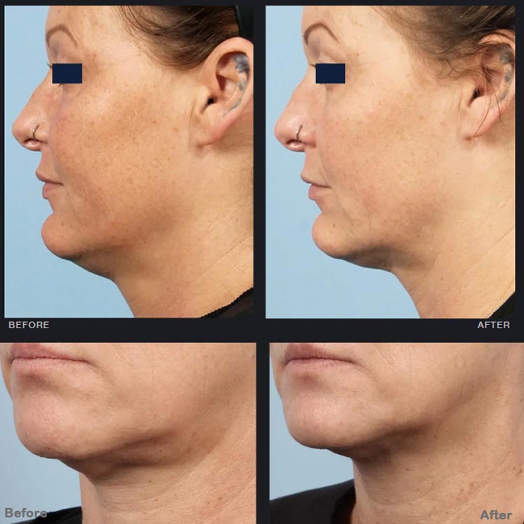 Radiofrequency (RF) Microneedling Matrix Pros skin wrinkle removal