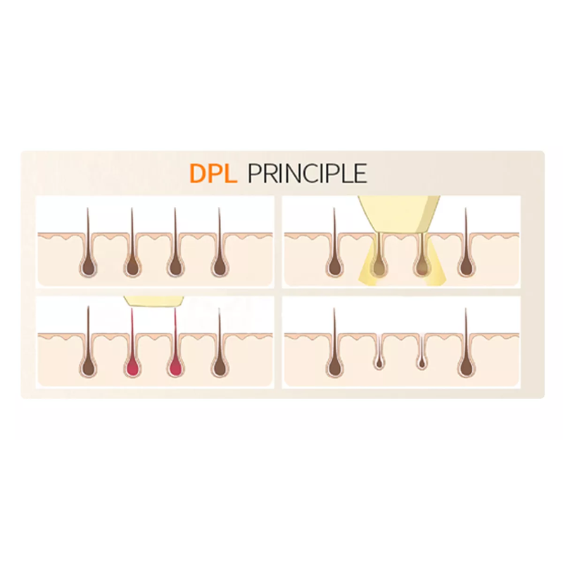 diode depilation machine DPL photon skin rejuvenation lifting anti-wrinkle and beauty machine