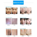 diode depilation machine DPL photon skin rejuvenation lifting anti-wrinkle and beauty machine