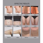 3 in 1 Salon Use Trusculpt Id Flex Rf Body Contouring Body Sculpting 2mhz Cellulite Treatment Fat Reduction Trufat Machine
