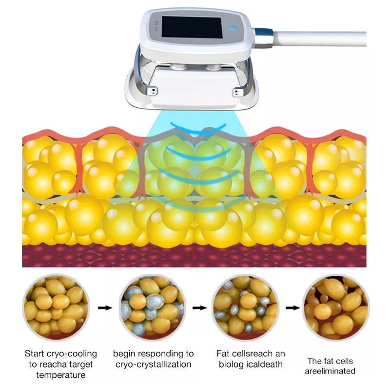 2022 360 Cryo Machine Cryolipolysis Best Price Fat Freezing Machine For Weight Loss Cryolipolysis