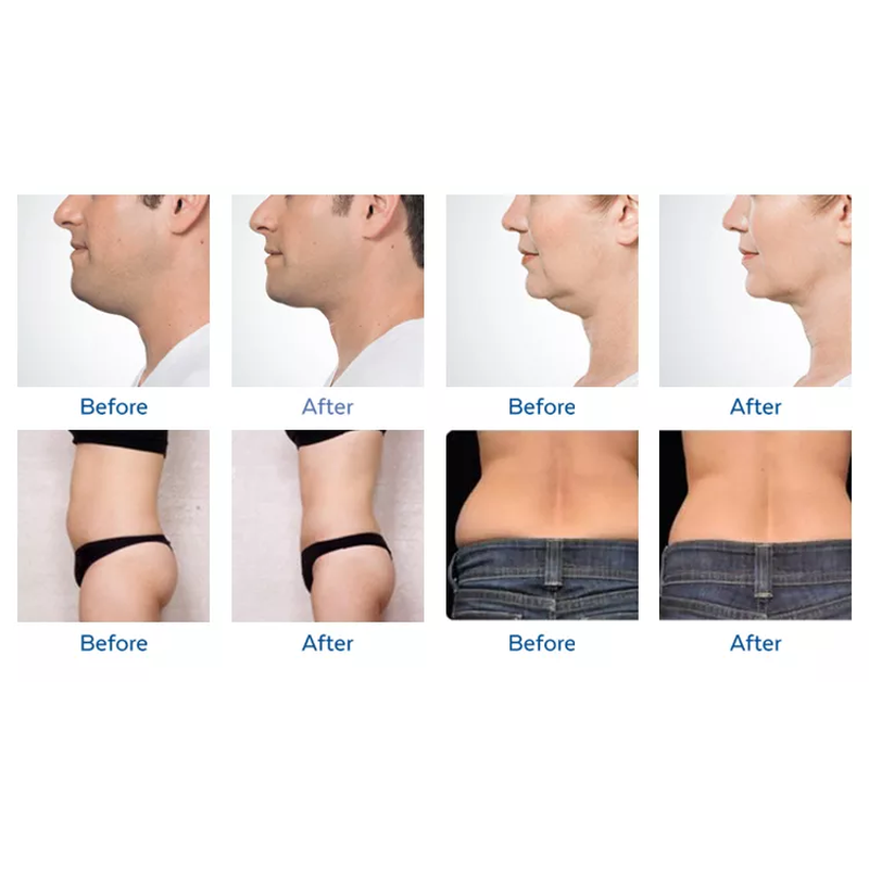 2022 360 Cryo Machine Cryolipolysis Best Price Fat Freezing Machine For Weight Loss Cryolipolysis