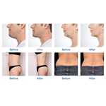 2022 360 Cryo Machine Cryolipolysis Best Price Fat Freezing Machine For Weight Loss Cryolipolysis