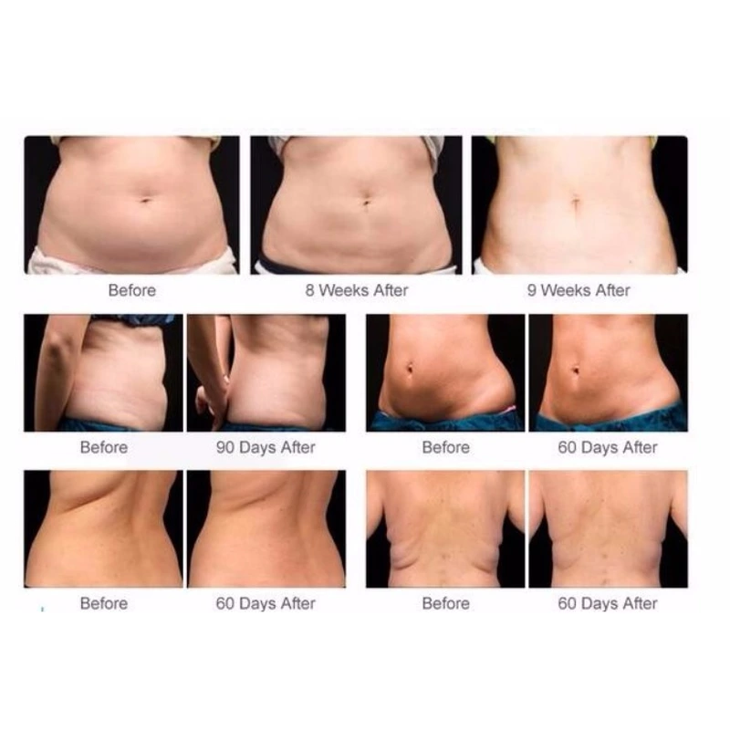 Best price cryolipolysis slimming machine cryotherapy weight lose fat freezing