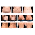 Best price cryolipolysis slimming machine cryotherapy weight lose fat freezing