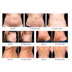 Best price cryolipolysis slimming machine cryotherapy weight lose fat freezing