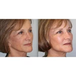 Radio Frequency Machine Mmfu Cyclone Rf Painless Face Lift Rf Machine For Skin Tightening Wrinkle Remover
