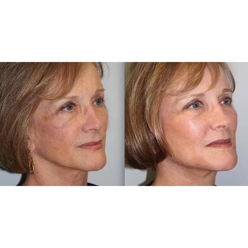 Radio Frequency Machine Mmfu Cyclone Rf Painless Face Lift Rf Machine For Skin Tightening Wrinkle Remover