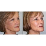 Radio Frequency Machine Mmfu Cyclone Rf Painless Face Lift Rf Machine For Skin Tightening Wrinkle Remover
