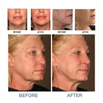 360 ° rotate display ultrasound skin rejuvenation Wrinkle Removal vertical 4D MMFU Machine