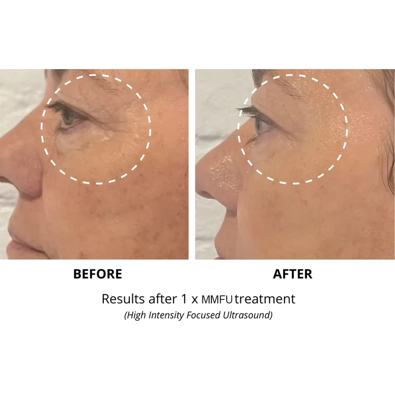 2 in 1 7D hifu RF face lift machine hifu face and body tighten Machine