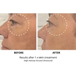 2 in 1 7D hifu RF face lift machine hifu face and body tighten Machine
