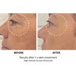 2 in 1 7D hifu RF face lift machine hifu face and body tighten Machine