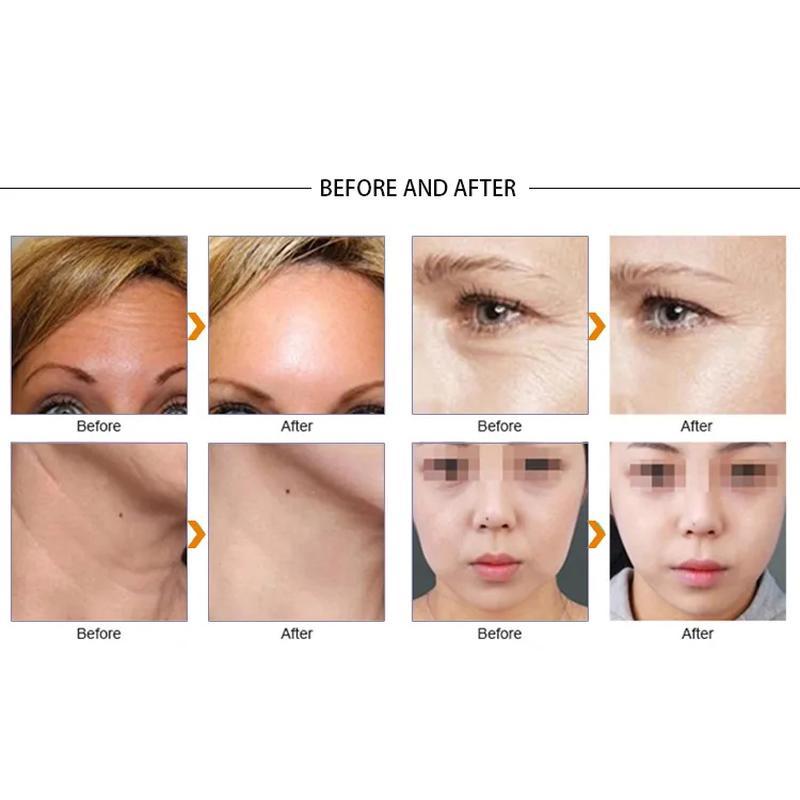 2023 New VDHF rf radio high frequency skin tightening machine best wrinkle remover equipment beauti lifting face care product