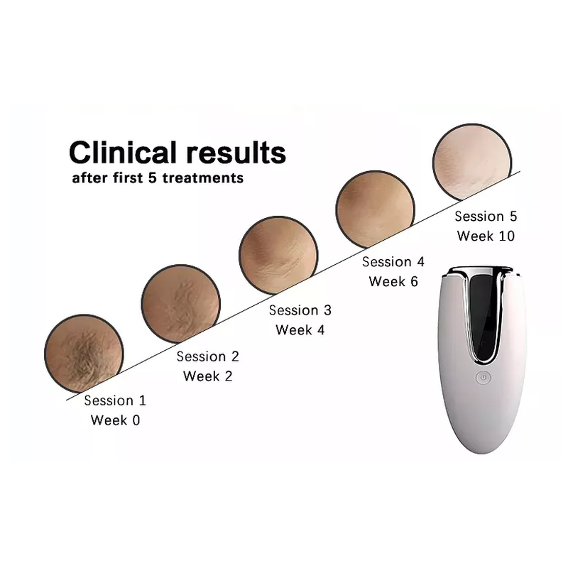 Home use trending products Hand held Hair Removal Laser Machine At Home Laser Hair Removal Portable