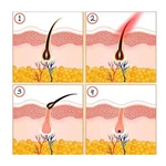 New type intense pulsed light therapy IPL hair removal machine