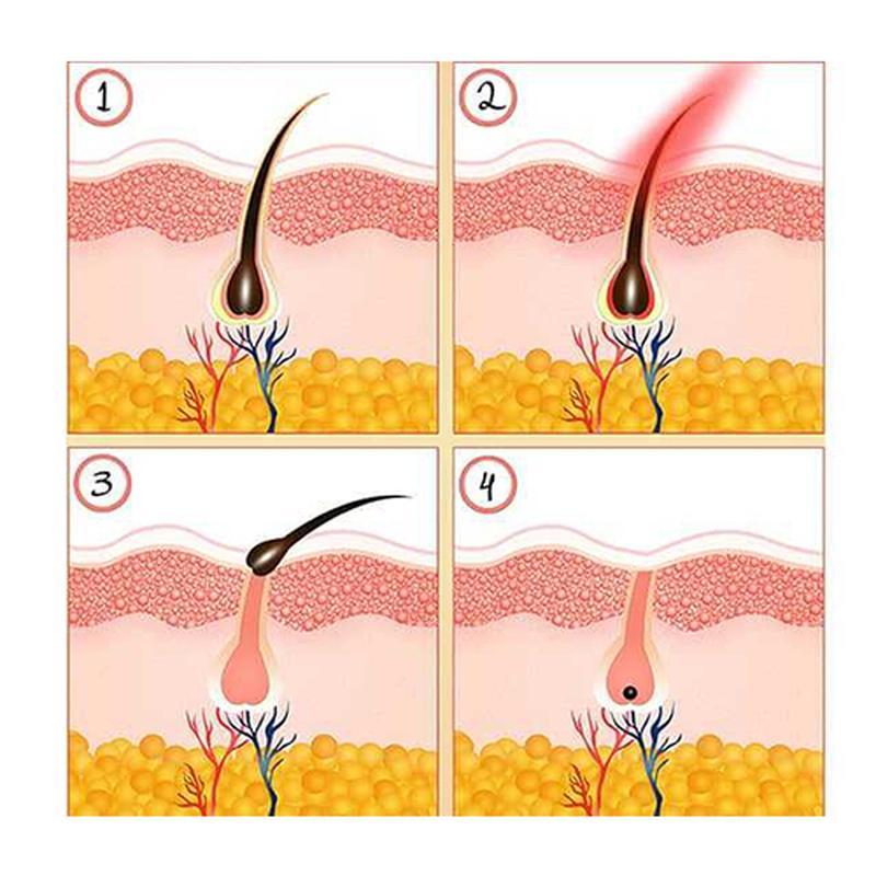 New type intense pulsed light therapy IPL hair removal machine