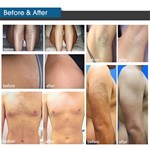 New type intense pulsed light therapy IPL hair removal machine