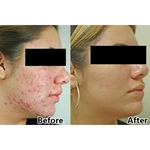 CE Approved Led Photodynamic Skin Rejuvenation And Acne Pdt Led Light Therapy Facial machine
