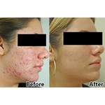 CE Approved Led Photodynamic Skin Rejuvenation And Acne Pdt Led Light Therapy Facial machine