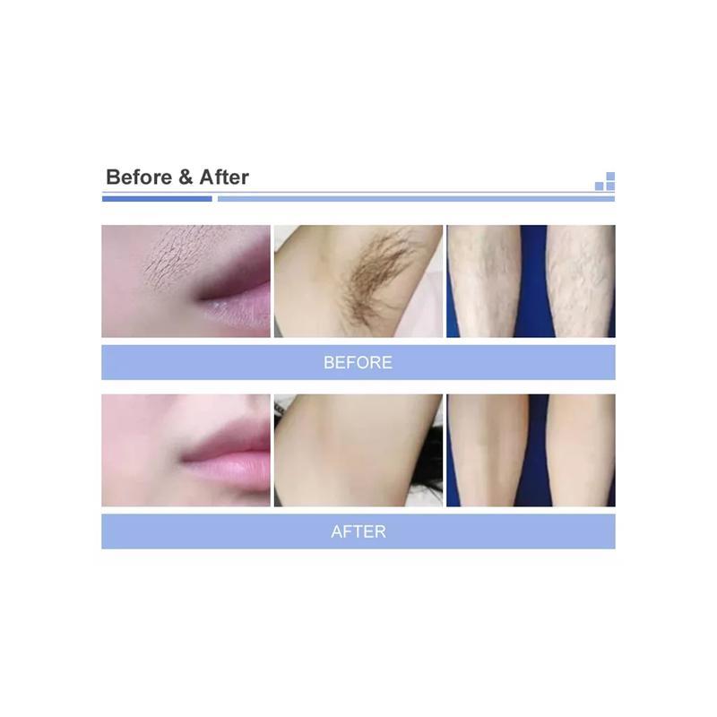 Dual Handles 3 Wavelength Laser Diode 808Nm Hair Removal Treatment Beauty Machine