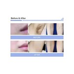 Dual Handles 3 Wavelength Laser Diode 808Nm Hair Removal Treatment Beauty Machine
