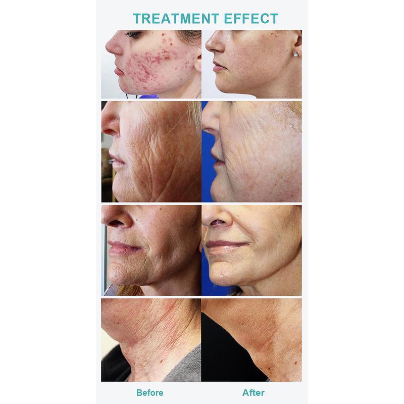 Professional Rf Microneedling Scarring Removal Skin Tightening Micro Needling Machine