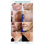 Professional Rf Microneedling Scarring Removal Skin Tightening Micro Needling Machine