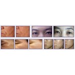 Plasma lifting machine plasma home beauty device