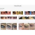 Beauty Plasma Pen Eye Lift Machine Jet plasma Lift For Skin Treatment Acne Machine
