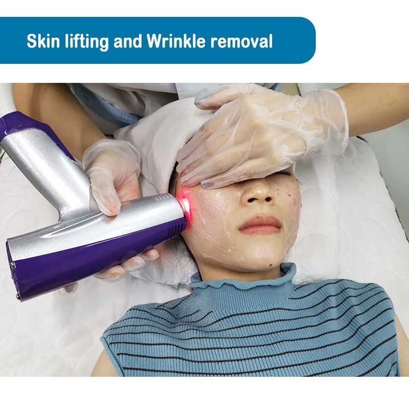 Radiofrequency (RF) Microneedling Matrix Pros skin wrinkle removal